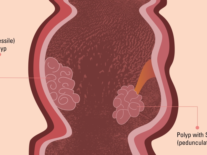 Graphic depicting sessile and pedunculated colon polyps