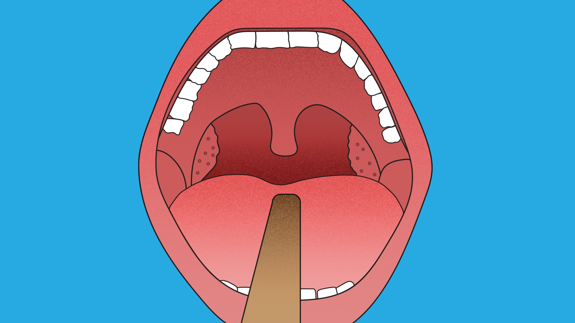 Difference Between Tonsillectomy And Adenoidectomy Tonsils And