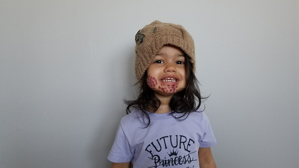 port wine birthmark photos