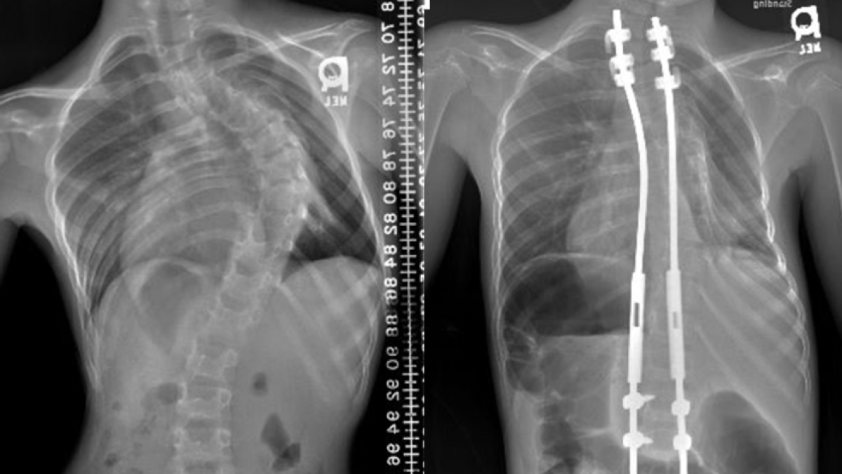 Searching for the best treatment for early-onset scoliosis