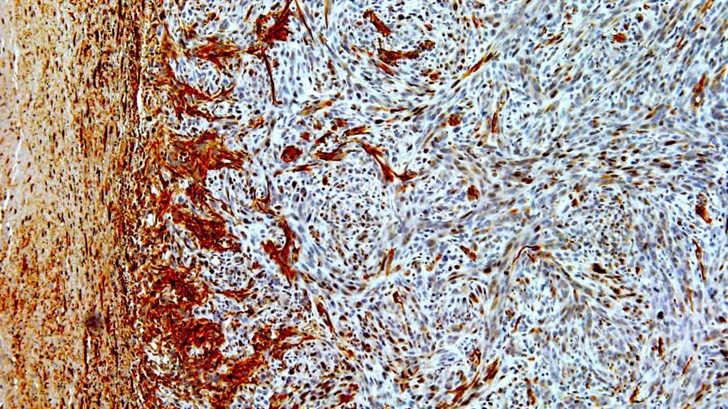 microscope cells glioma