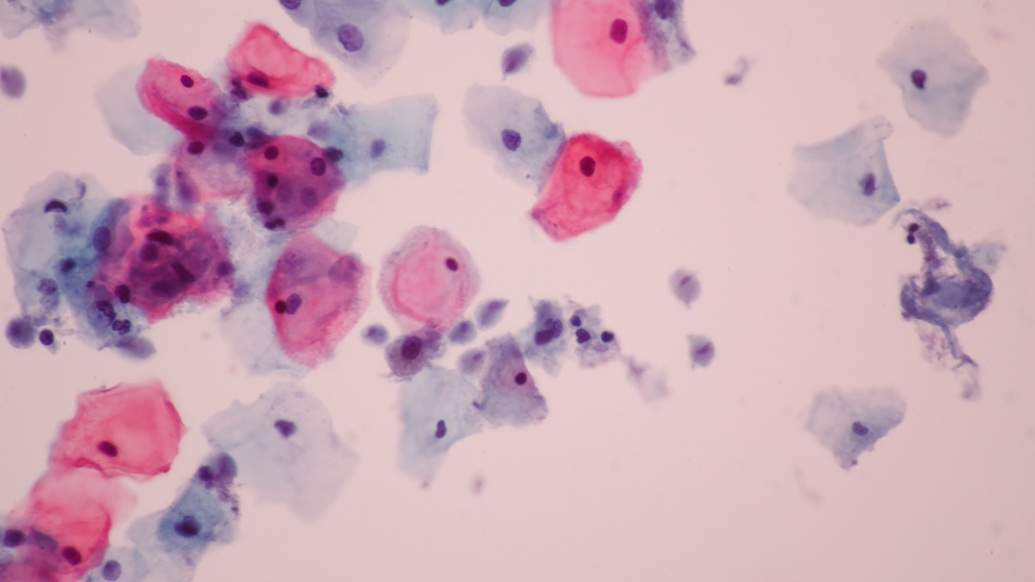 A microscopic image of an infection shown from a Pap test
