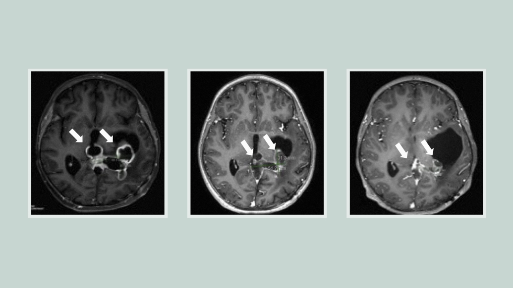 glioma brain scan