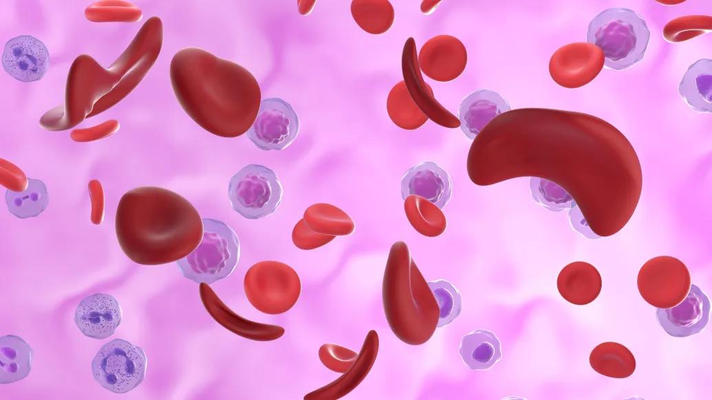 sickle cell gene therapy pink
