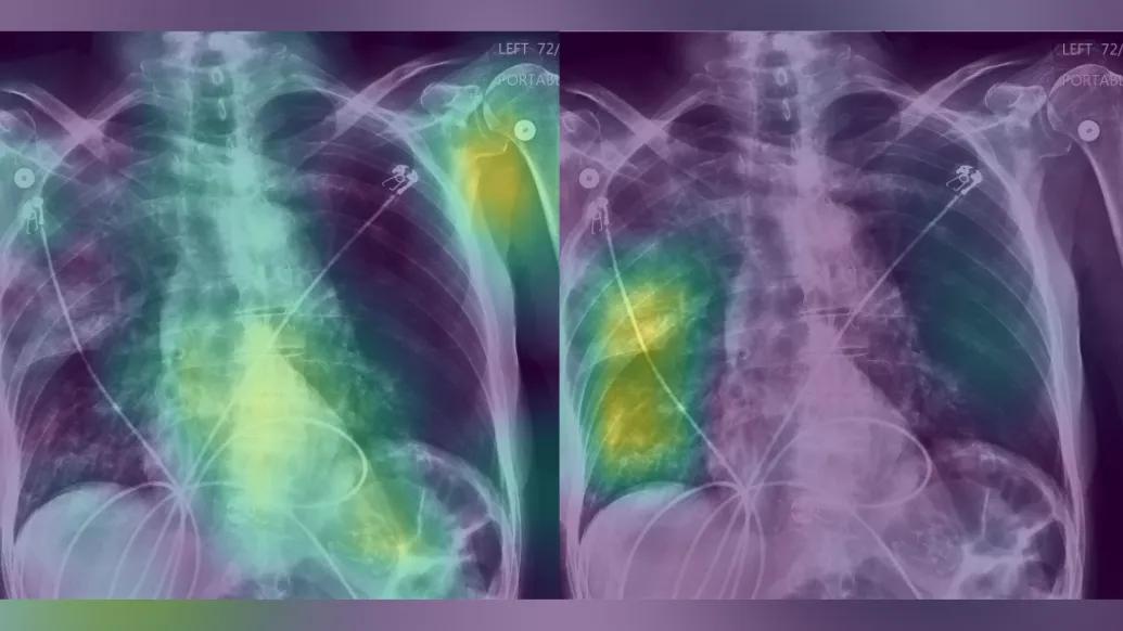x-ray rib lung purple
