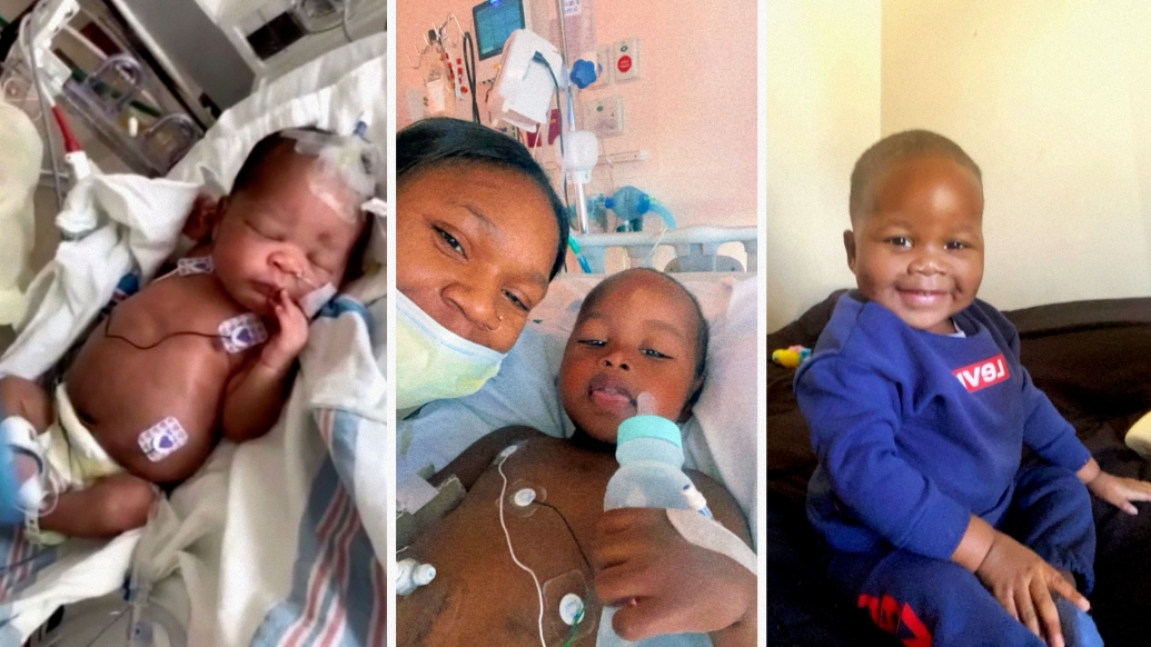 Dinero is back to being an active toddler following a kidney transplant