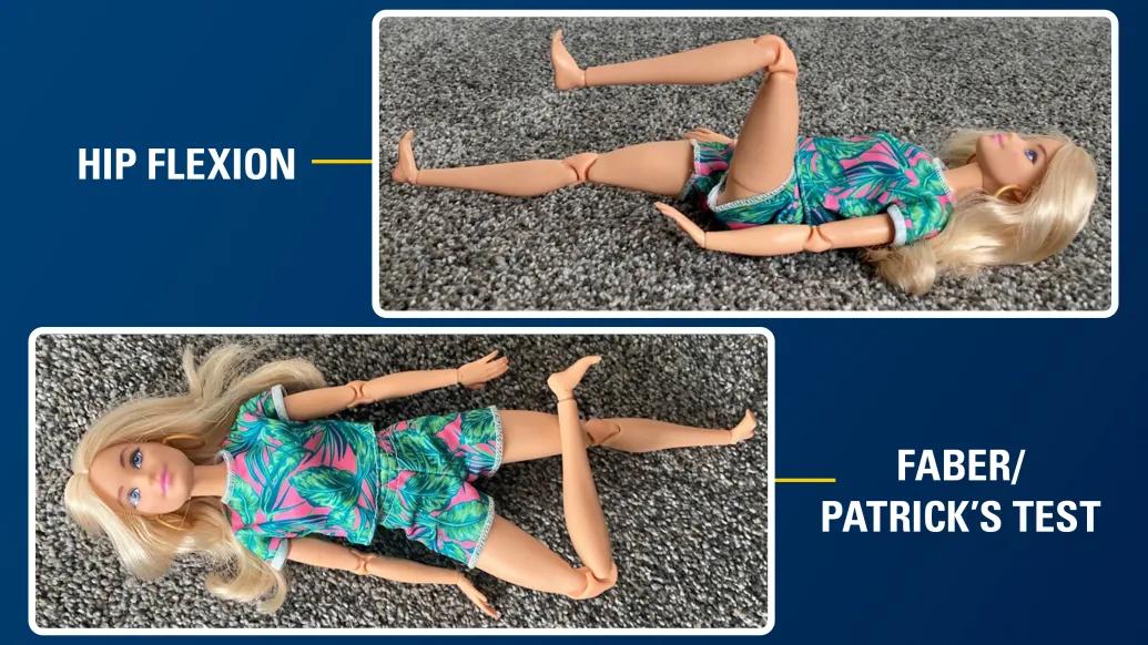 Barbie doll placed in stretching positions for a visual aid for doctors
