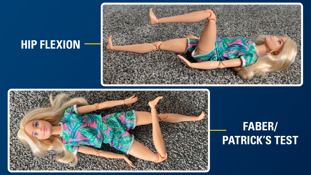 Barbie doll placed in stretching positions for a visual aid for doctors