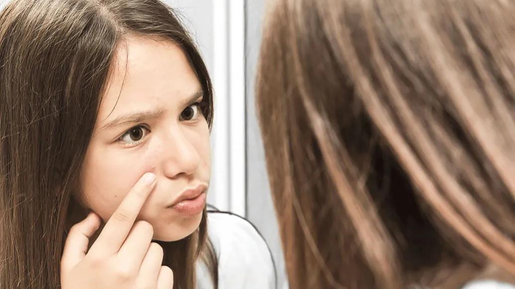 Acne your child