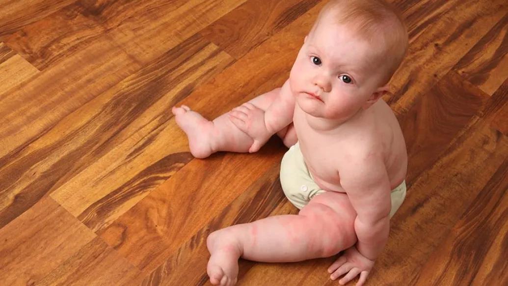 Eczema