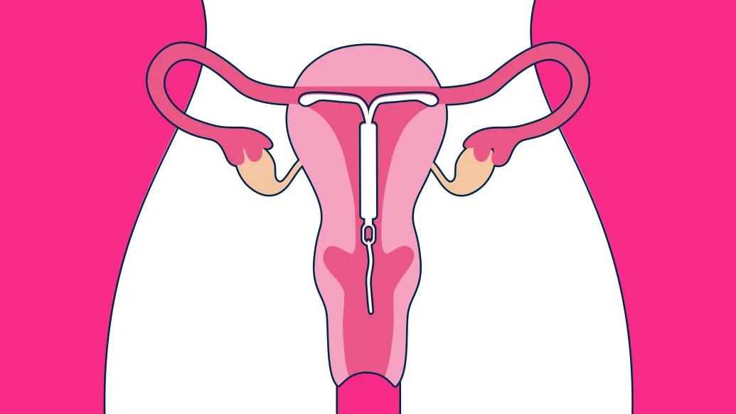 uterus pink background white body outline seeing white IUD