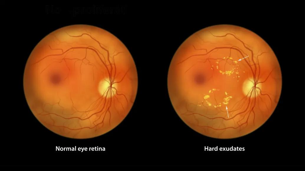 two photos of the back of an eye 
