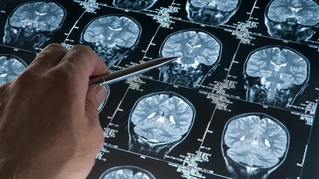 xray brain images on repeat and person pointing with pointer