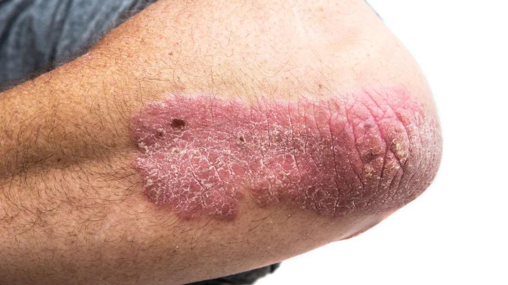 red rash on elbow