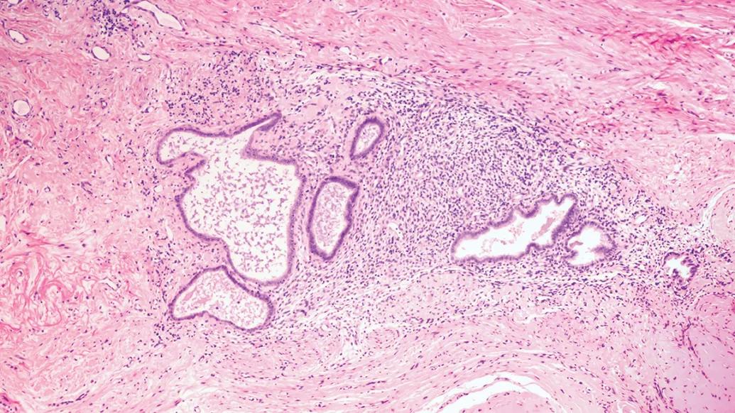 Microscopic section of endometriosis that has been dyed pink. 