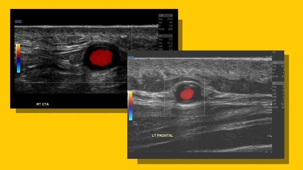 ultrasound scan on yellow background with red dot found in two images