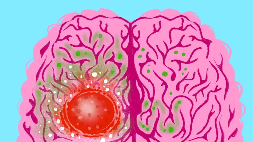 light blue background with pink brain with red circle area growing