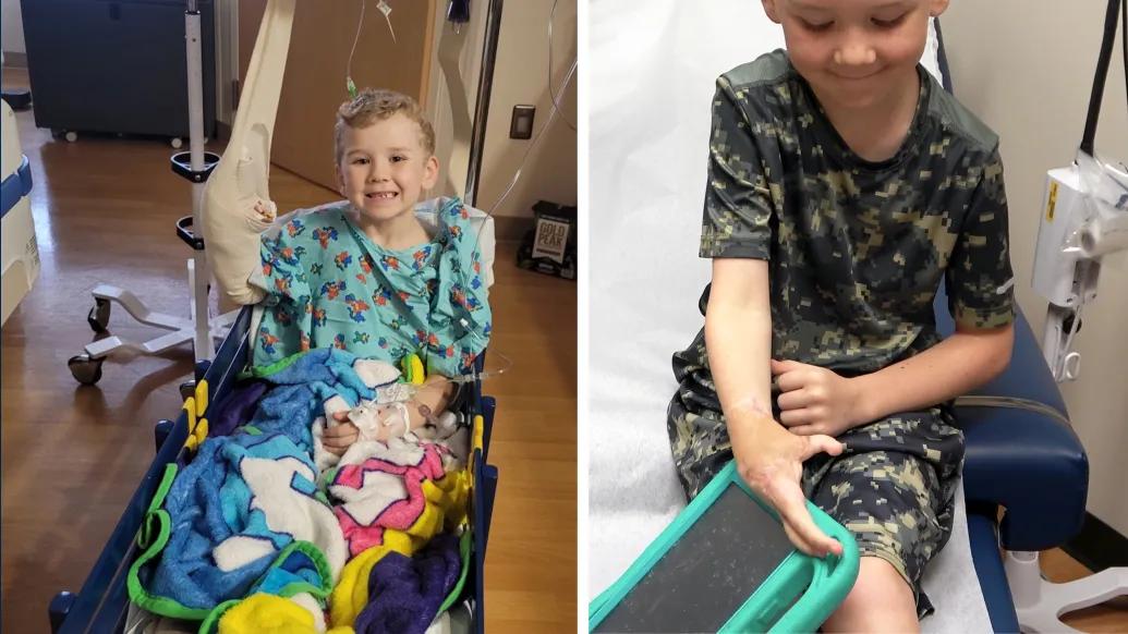 kid in wheel chair smiling and then on right is hand reconstructed