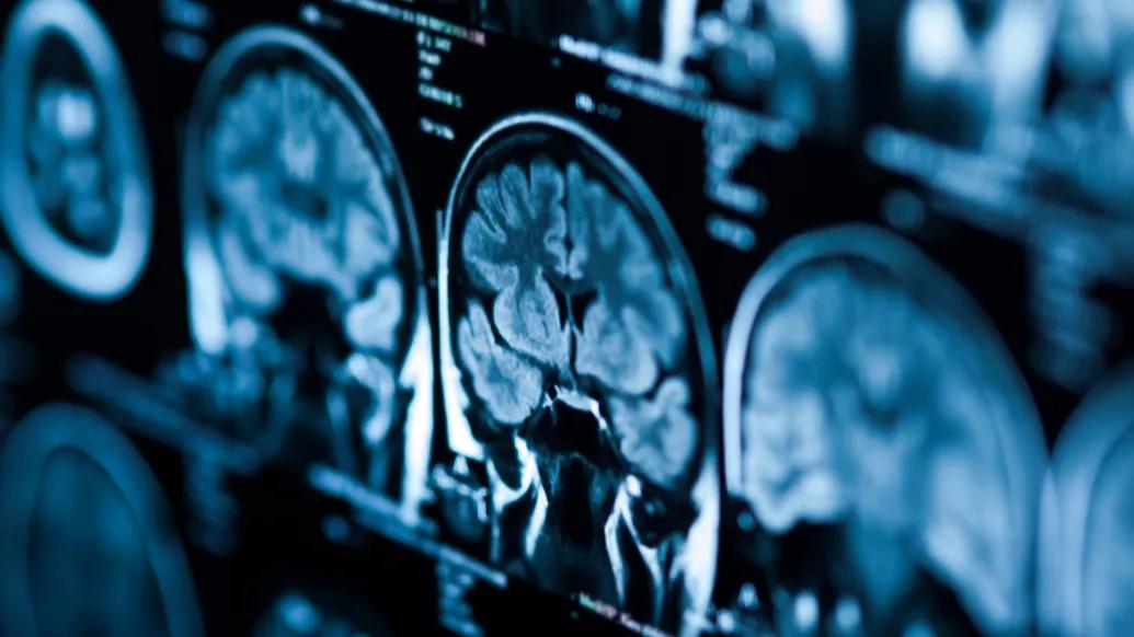 MRI of brain