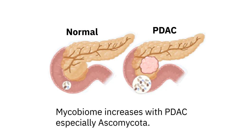normal pancreas drawing and one labeled PDAC