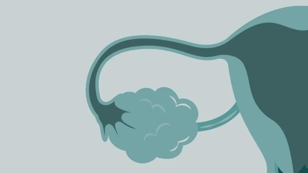 A stylized medical illustration of a fallopian tube and ovary (part of the female reproductive system).