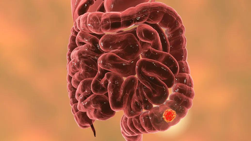 Colorectal cancer is no longer just a disease of older adults