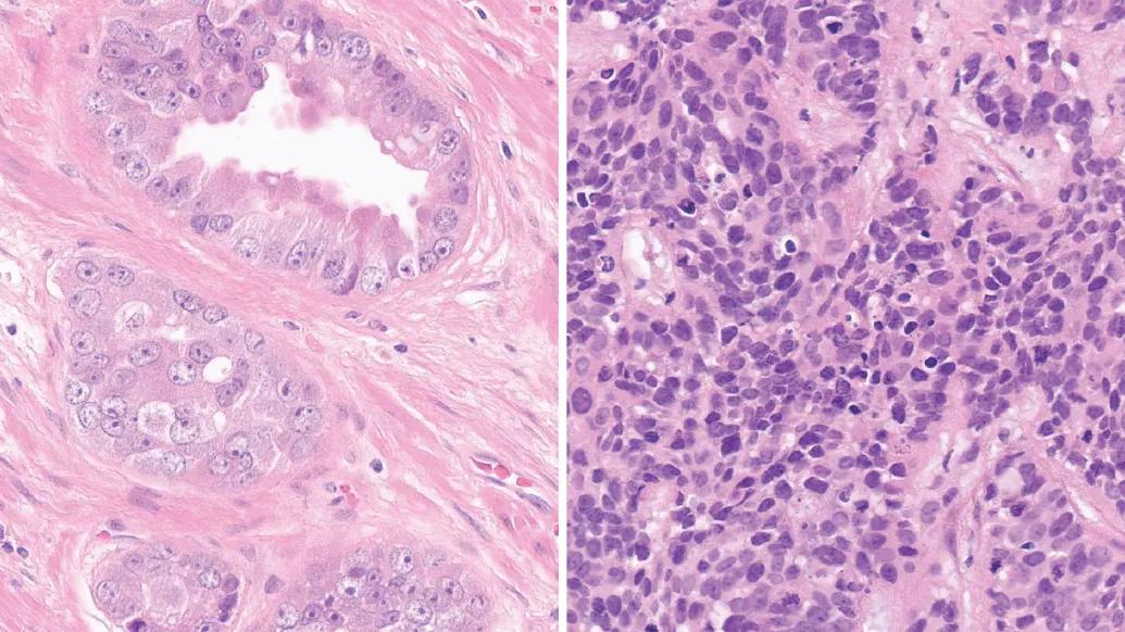 Microscope images of prostate cancer cells
