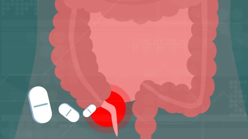 Appendicitis treated with antibiotics