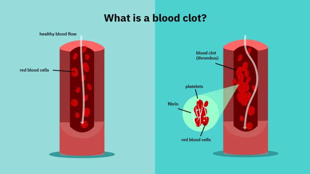What is a blood clot image, illustrating healthy blood flow, red blood cells, blood clots, platelets, fibrin and red blood cells  