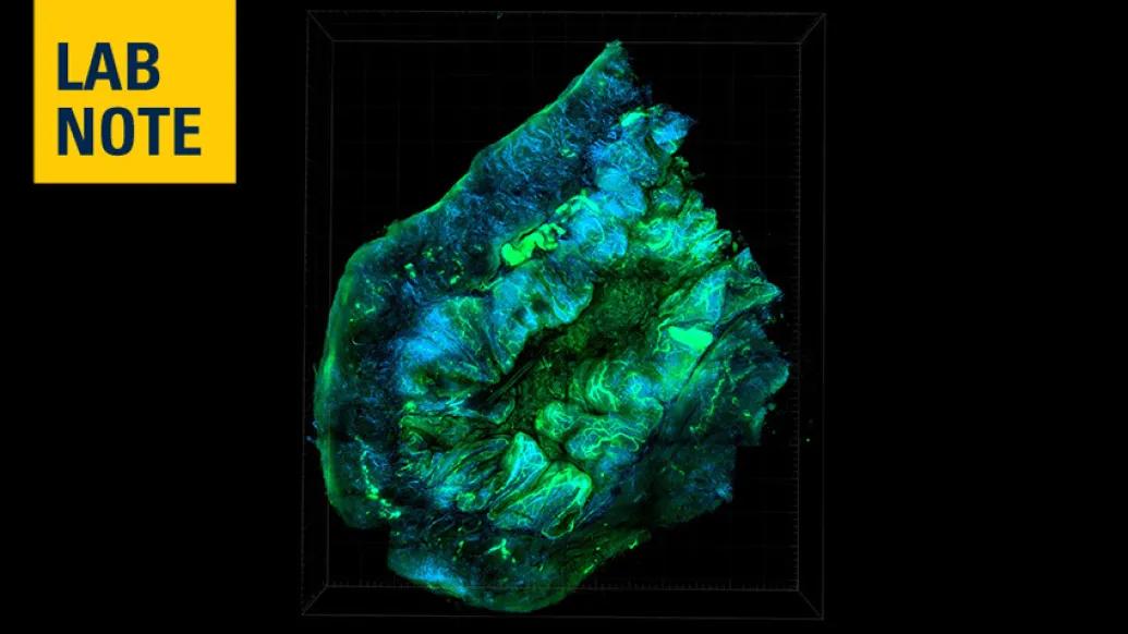 ovarian cancer tumor under microscope lab note
