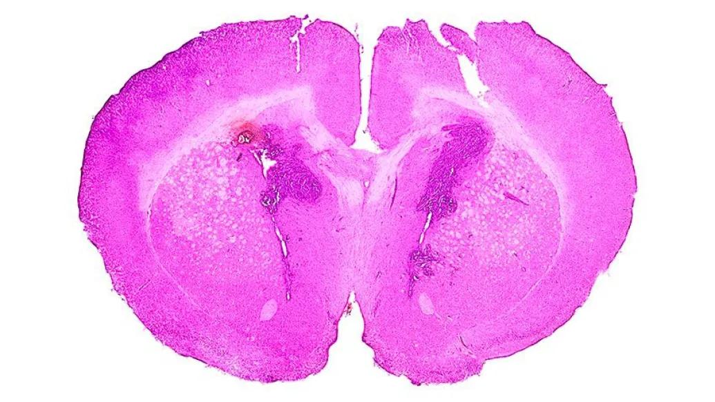 pink brain cross section pink tumor
