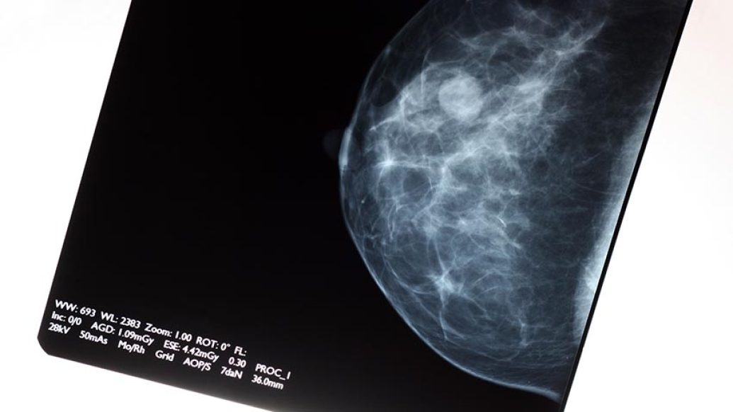 Breast cancer scan image