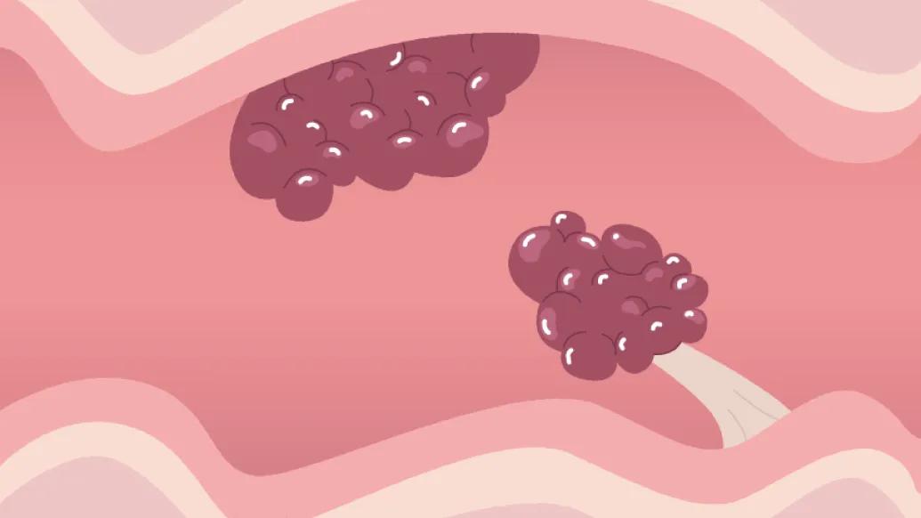 colon interior polyps in stomach lining drawing