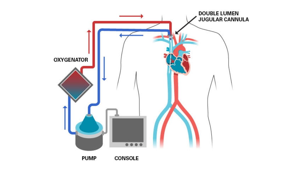 oxygenator, pump, console, double lumen jugular cannula diagram of ECMO