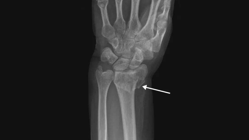 forearm wrist bone fracture with arrow pointing to it on xray