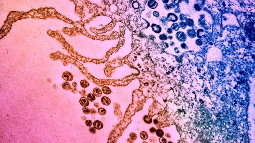 HIV attacking cells in purple pink and red