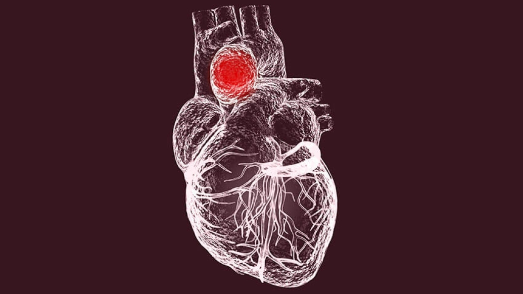 Heart model aneurysm aorta veins