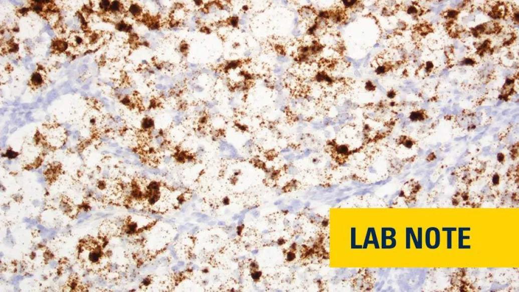 kidney cancer microscopic gene biomarker image with words "lab note" in bottom right in yellow and blue font