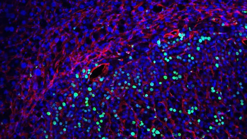 liver cancer cells microscopic cells