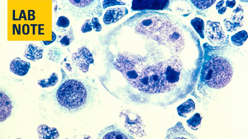 lymphoma microscopic cells image blue
