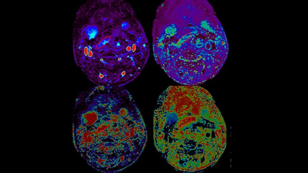 MRI perfusion flap scan highlight