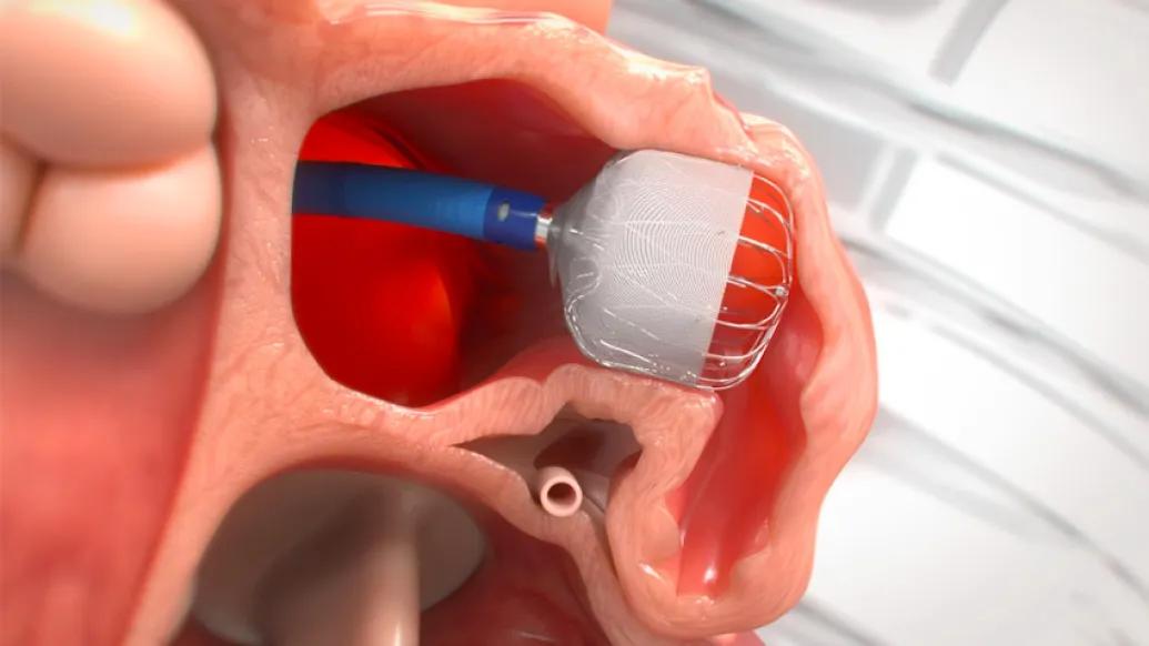 Medical Device 3D Render Heart
