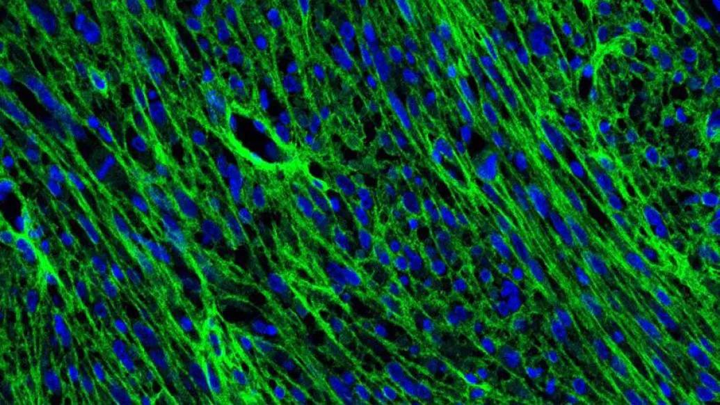 microscopic collagen tumor green blue