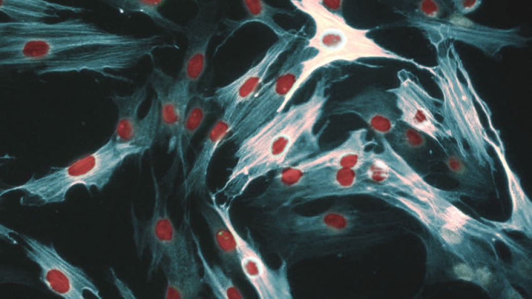 Muscle fiber microscopic scleroderma fibrosis