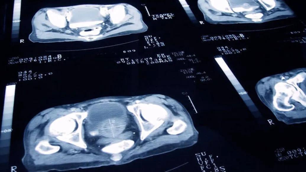 a slide showing prostate cancer