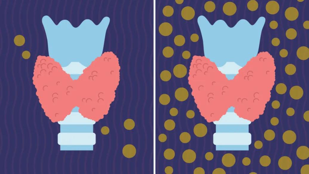 Graphic of thyroid with thyroid disease vs. a healthy thyroid