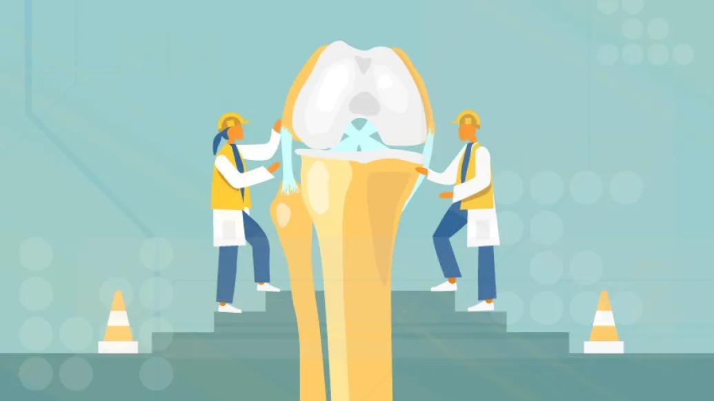 Knee replacement 