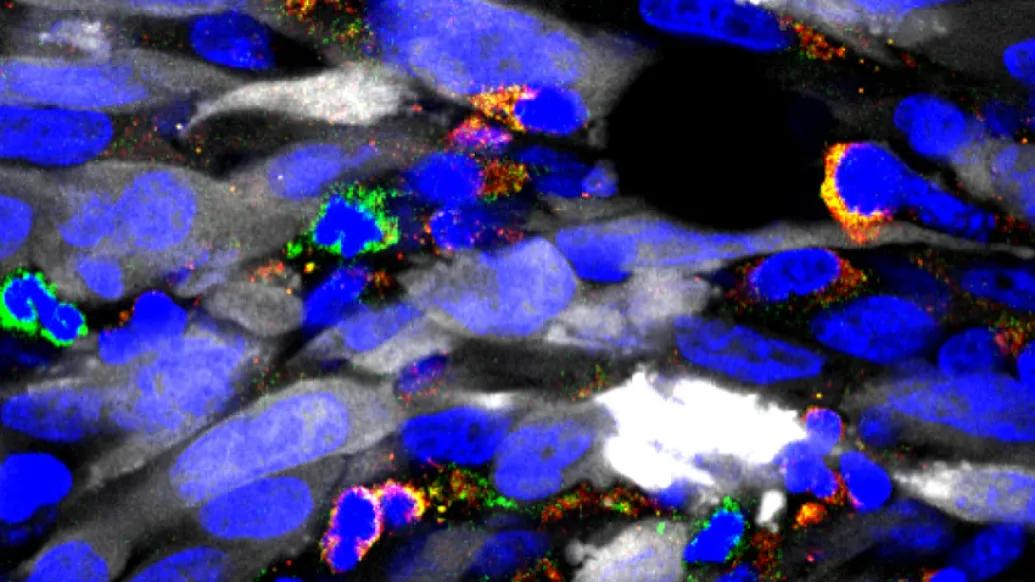 Microscopic image of glioblastoma multiforme