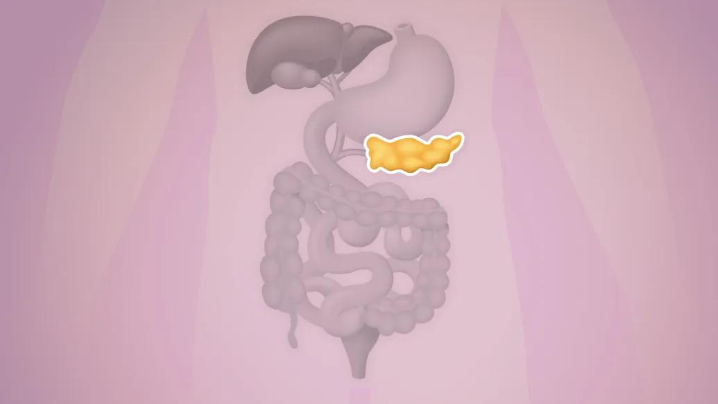 Graphic showing potential pancreatic cancer