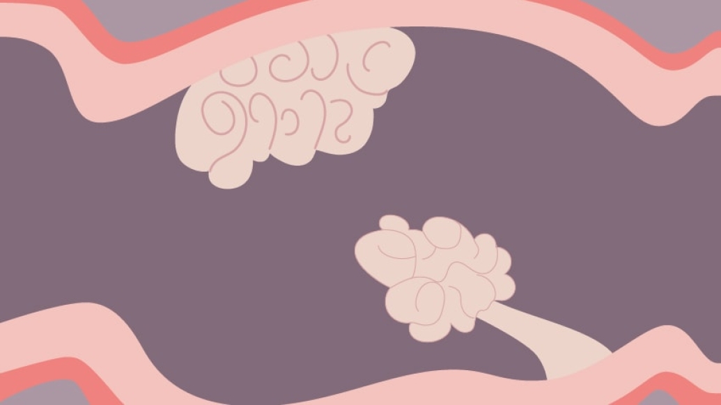 pink intestine with polyps growing graphic illustration